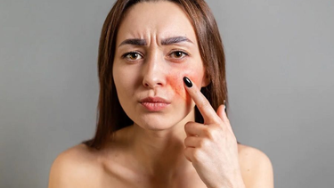 Da mỏng lộ mao mạch là do đâu? Cách khắc phục hiệu quả