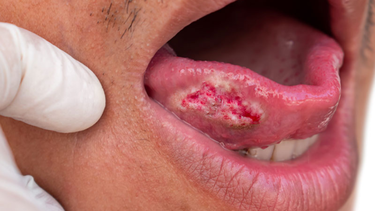 Đặc điểm hình ảnh ung thư lưỡi giai đoạn cuối