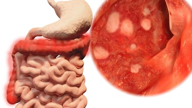 Dấu hiệu nhận biết viêm đại tràng bạn không nên bỏ qua
