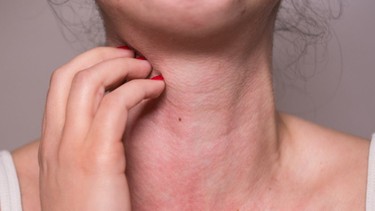 Dị ứng cá: Nguyên nhân, dấu hiệu và cách xử lý