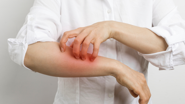 Dị ứng hạnh nhân là gì? Dấu hiệu nhận biết và cách xử trí an toàn