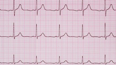 Điện tim bình thường là gì? Cách nhận biết và ý nghĩa trong chẩn đoán tim mạch