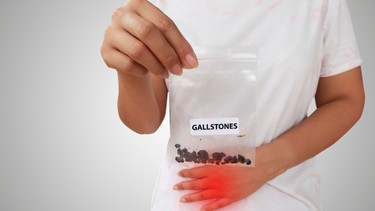 Điều trị sỏi mật​ như thế nào? Một số thực phẩm hỗ trợ tan sỏi mật