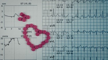 Đo ECG là gì? Quy trình đo ECG và một số lưu ý bạn cần biết