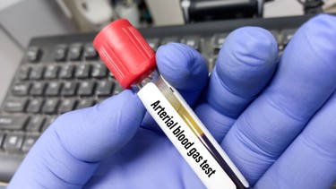 Đọc khí máu động mạch: Hướng dẫn chuẩn để hiểu nhanh và ứng dụng đúng