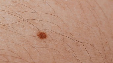 Đốm nâu trên da là gì? Các biện pháp cải thiện vùng da sẫm màu