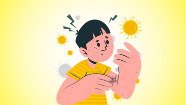 Đừng xem thường: Sởi có khả năng lây nhanh hơn bạn nghĩ