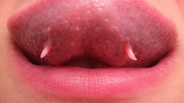 Dưới lưỡi có sợi thịt là gì? Nguyên nhân thường gặp và khi nào cần chú ý
