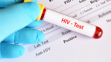 Dương tính giả HIV là gì? Nguyên nhân gây ra kết quả dương tính giả