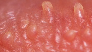 Gai sinh dục có tự hết không? Những điều cần hiểu đúng về gai sinh dục