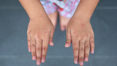 Gần 3.000 trẻ mắc chân tay miệng trong 2 tháng, 3 dấu hiệu cần đưa con đi viện