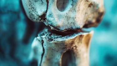 Gãy xương cánh tay: Nguyên nhân, dấu hiệu và cách điều trị hiệu quả