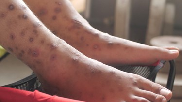Ghẻ chân: Nguyên nhân, triệu chứng và cách điều trị