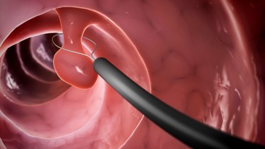 Giải đáp chi phí cắt polyp đại tràng và các yếu tố quyết định