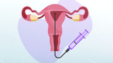Vòi trứng thông hạn chế có làm IUI được không? Khi nào nên chuyển sang IVF?
