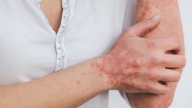Giang mai giai đoạn 2: Những vấn đề bạn nên biết
