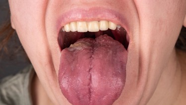 Giang mai ở lưỡi: Những điều bạn cần lưu ý