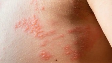 Giời leo có lây không? Cách phòng tránh lây nhiễm hiệu quả