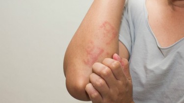 Giun đầu gai là gì? Nguyên nhân, triệu chứng, chẩn đoán và điều trị 