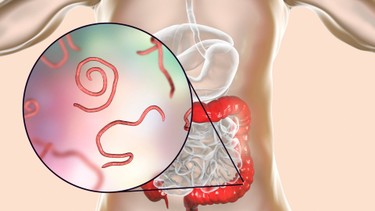 Giun kim là gì? Giun kim thường gặp trên đối tượng nào?