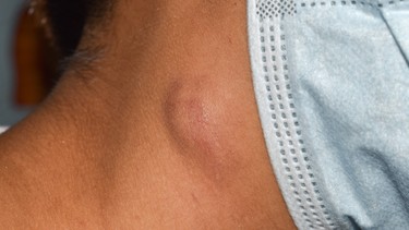 Hạch HIV có đặc điểm gì? Cách nhận diện và phân biệt với hạch thông thường