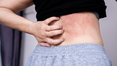 Hay bị mẩn ngứa mùa hè: Nguyên nhân và cách xử trí