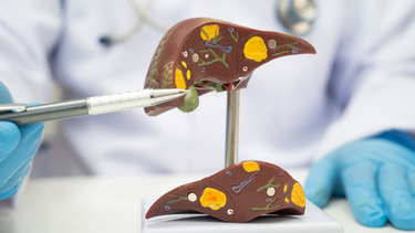 Hemangioma gan là gì? Nguyên nhân và cách theo dõi an toàn