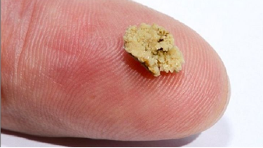 Hẹp khúc nối bể thận niệu quản được chẩn đoán và điều trị như thế nào?