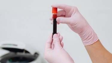 Hiểu chỉ số xét nghiệm tan máu bẩm sinh ở trẻ em và cách đọc kết quả