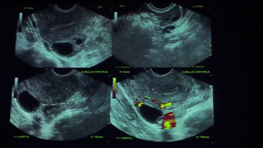 Hình ảnh siêu âm trứng sắp rụng: Dấu hiệu nhận biết và ý nghĩa trong theo dõi chu kỳ sinh sản