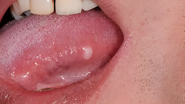 Hình ảnh ung thư lưỡi qua từng giai đoạn có đặc điểm gì?