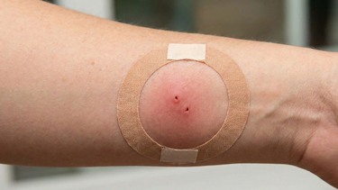 Hình ảnh vết chuột cắn: Cách nhận biết, mức độ nguy hiểm và xử trí đúng