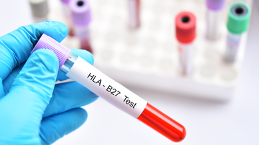 HLA B27 là gì? Khi nào cần xét nghiệm HLA B27?