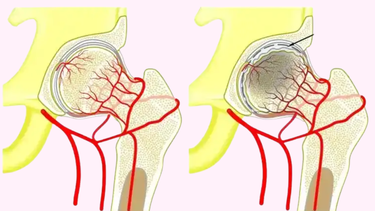 Hoại tử chỏm xương đùi là gì? Nguyên nhân và cách điều trị