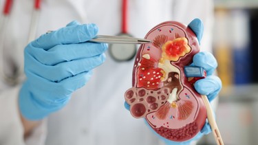 Hội chứng thận hư là gì? Nguyên nhân, triệu chứng và cách điều trị hiệu quả