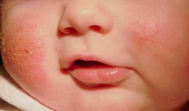 Chàm sữa và mụn sữa khác nhau như thế nào? Cách chăm sóc an toàn, hiệu quả cho bé