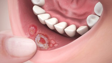 Hướng dẫn cách trị nhiệt miệng an toàn, hiệu quả, dễ áp dụng