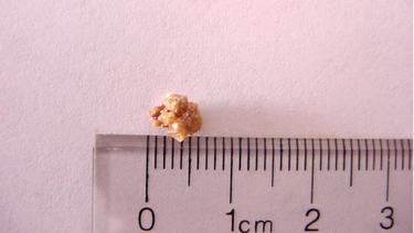 Hướng dẫn chi tiết cách lập kế hoạch chăm sóc bệnh nhân sỏi niệu quản