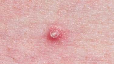 Khi cậu nhỏ nổi mụn trắng không ngứa​ có nguy hiểm không?