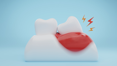 Không nhổ răng khôn có sao không? Khi nào an toàn và những rủi ro cần biết