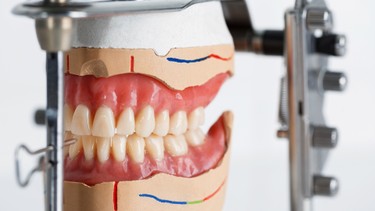 Khớp cắn đối đầu là gì? Những ảnh hưởng của khớp cắn đối đầu đến sức khỏe