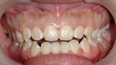 Khớp cắn hở là gì? Nguyên nhân, dấu hiệu và cách khắc phục hiệu quả