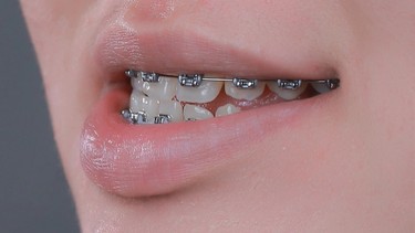 Khớp cắn ngược loại 3: Nhận diện và giải pháp điều trị hiệu quả