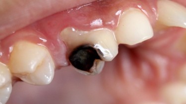 Làm gì khi trẻ bị sâu răng sữa và cách xử lý đúng đắn cha mẹ cần biết