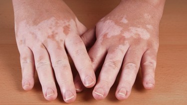 Lang ben trắng: Nguyên nhân, triệu chứng và cách phòng ngừa