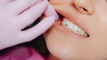 Lấy tủy răng số 7 bao nhiêu tiền​? Răng số 7 lấy tủy có phức tạp không?