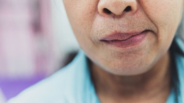 Liệt mặt ngoại biên: Nguyên nhân, dấu hiệu và cách điều trị