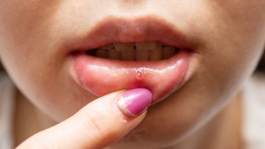 Lở loét miệng HIV: Nguyên nhân, xử trí và cách phòng ngừa