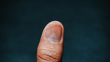 Loạn dưỡng móng: Dấu hiệu nhận biết, nguyên nhân và cách chăm sóc đúng cách