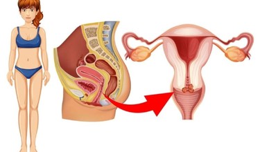 Loạn sản cổ tử cung có chữa khỏi được không?